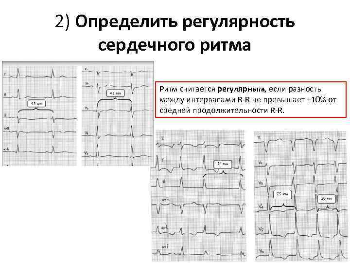 2) Определить регулярность сердечного ритма Ритм считается регулярным, если разность между интервалами R-R не