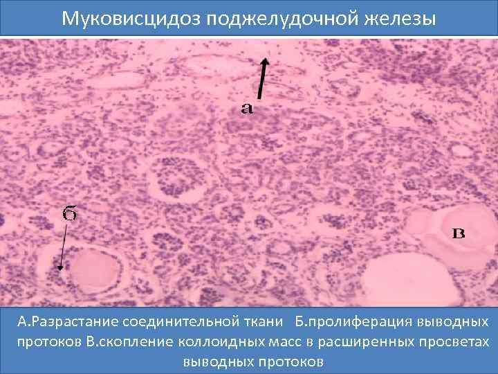 Муковисцидоз поджелудочной железы А. Разрастание соединительной ткани Б. пролиферация выводных протоков В. скопление коллоидных