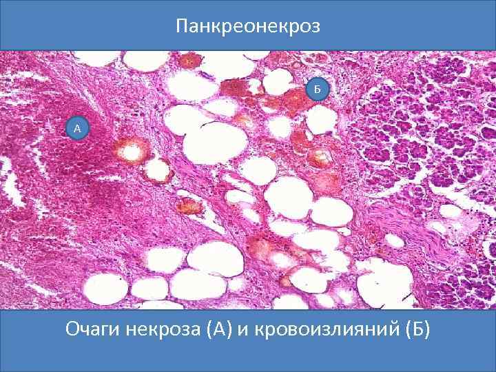 Панкреонекроз Б А Очаги некроза (А) и кровоизлияний (Б) 
