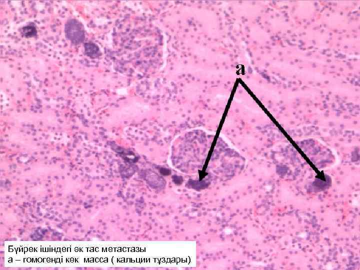 Бүйрек ішіндегі әк тас метастазы а – гомогенді көк масса ( кальции тұздары) 