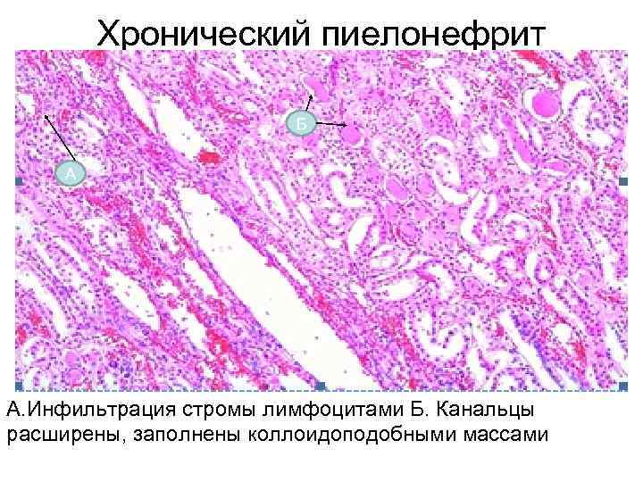 Хронический пиелонефрит микроскопическая картина