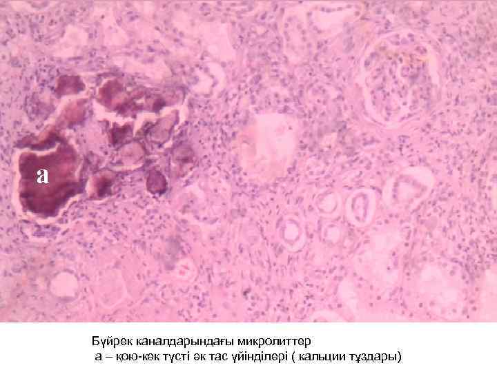 Бүйрек каналдарындағы микролиттер а – қою-көк түсті әк тас үйінділері ( кальции тұздары) 