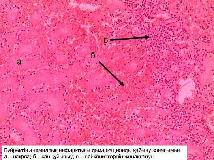 Бүйректің анемиялық инфарктысы демаркационды қабыну зонасымен а – некроз; б – қан құйылыу; в
