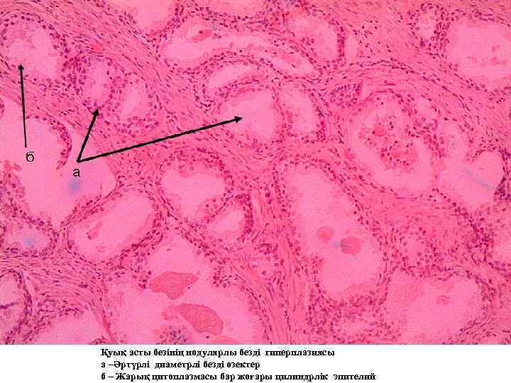 Қуық асты безінің нодулярлы безді гиперплазиясы а –Әртүрлі диаметрлі безді өзектер б – Жарық