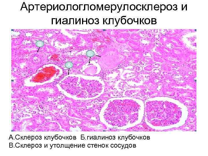 Артериолосклеротический нефросклероз рисунок