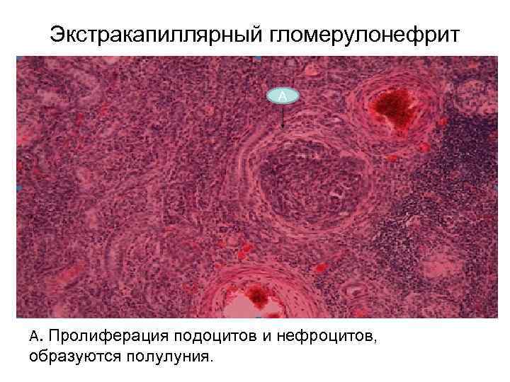 Экстракапиллярный гломерулонефрит А А. Пролиферация подоцитов и нефроцитов, образуются полулуния. 