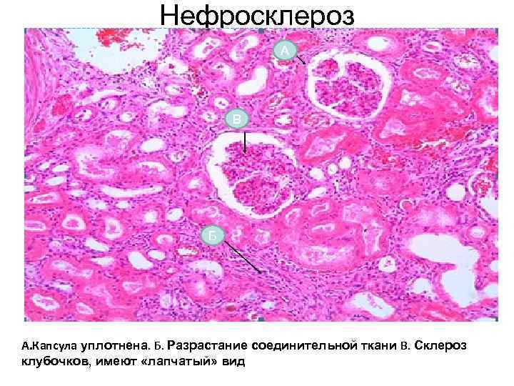 Нефросклероз • ка А В Б А. Капсула уплотнена. Б. Разрастание соединительной ткани В.