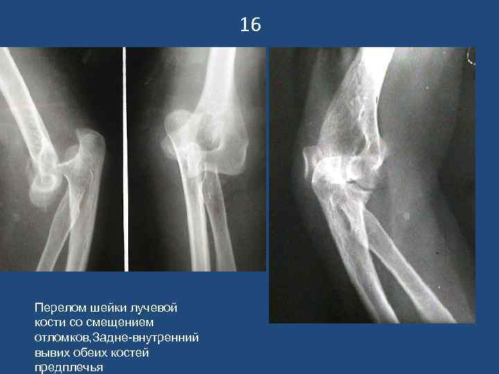 16 Перелом шейки лучевой кости со смещением отломков, Задне-внутренний вывих обеих костей предплечья 