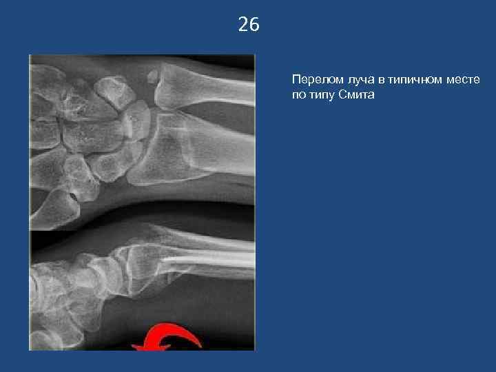 Перелом смита и колеса презентация