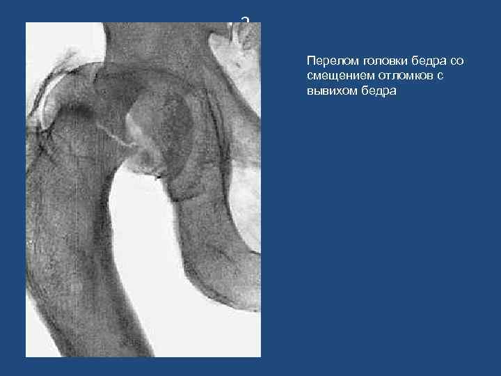 3 Перелом головки бедра со смещением отломков с вывихом бедра 