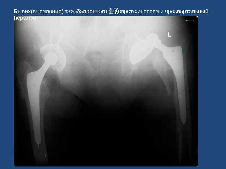 17 Вывих(выпадение) тазобедренного эндопротеза слева и чрезвертельный перелом 