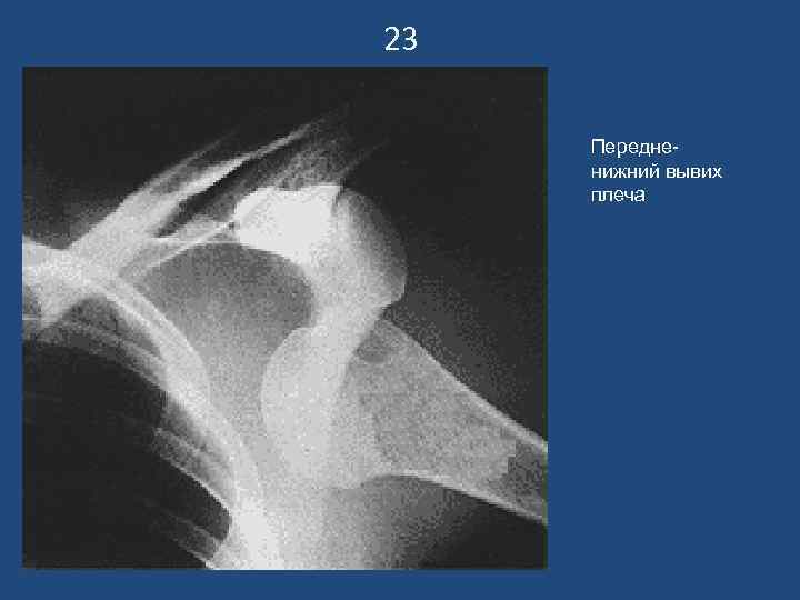 23 Передненижний вывих плеча 