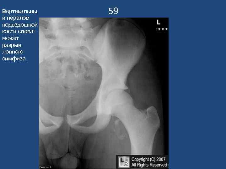 Вертикальны й перелом подвздошной кости слева+ может разрыв лонного симфиза 59 