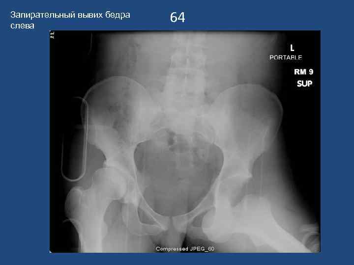 Запирательный вывих бедра слева 64 