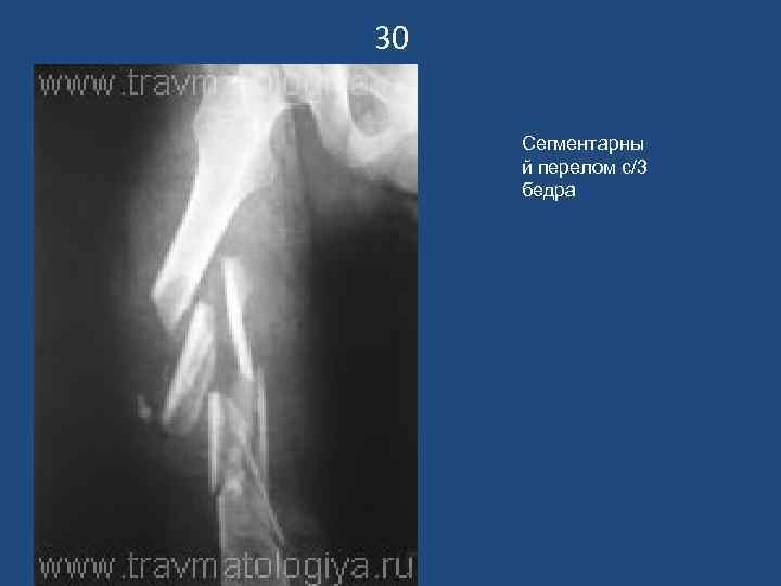 30 Сегментарны й перелом с/3 бедра 