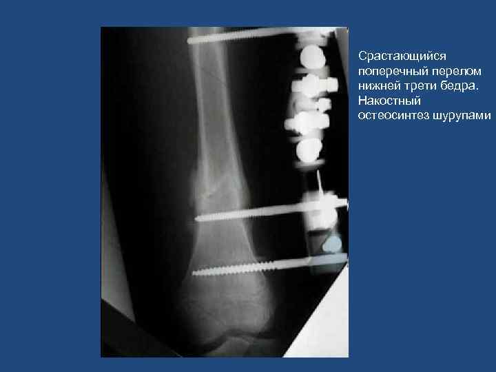 Срастающийся поперечный перелом нижней трети бедра. Накостный остеосинтез шурупами 