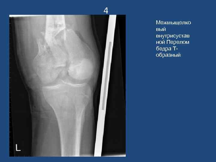 4 Межмыщелко вый внутрисустав ной Перелом бедра Тобразный 