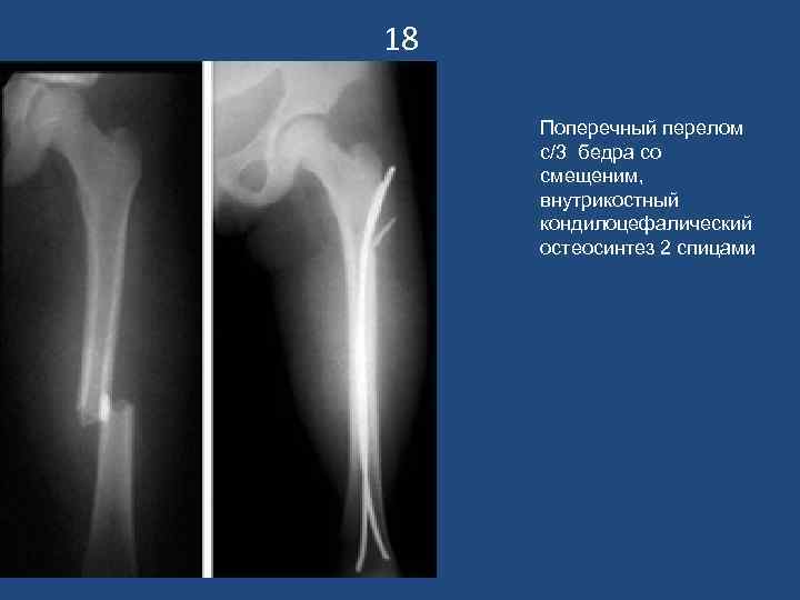 18 Поперечный перелом с/3 бедра со смещеним, внутрикостный кондилоцефалический остеосинтез 2 спицами 