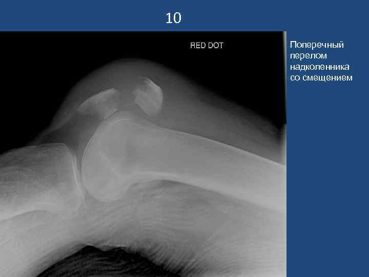 10 Поперечный перелом надколенника со смещением 