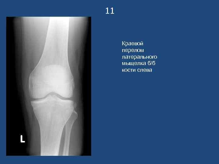 11 Краевой перелом латерального мыщелка б/б кости слева 