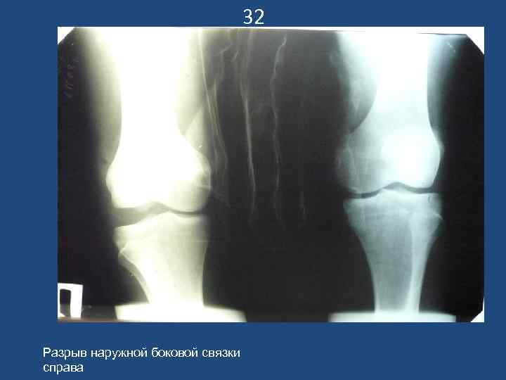 32 Разрыв наружной боковой связки справа 