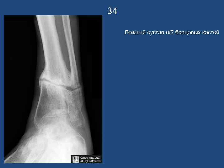 34 Ложный сустав н/3 берцовых костей 