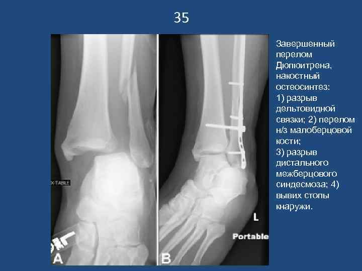 35 Завершенный перелом Дюпюитрена, накостный остеосинтез: 1) разрыв дельтовидной связки; 2) перелом н/з малоберцовой