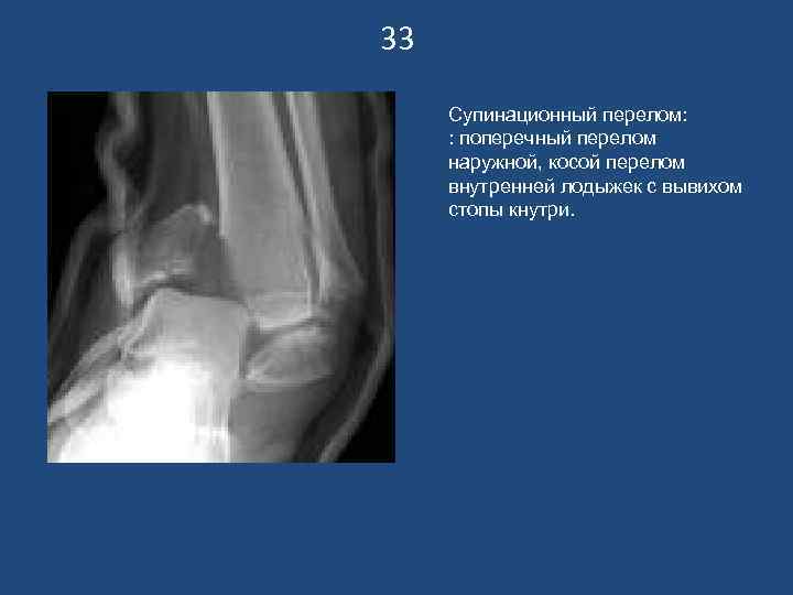 33 Супинационный перелом: : поперечный перелом наружной, косой перелом внутренней лодыжек с вывихом стопы