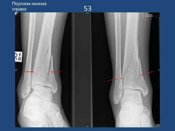 Перелом пилона справа 53 