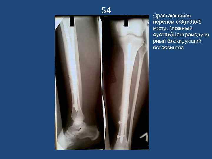 54 Срастающийся перелом с/3(н/3)б/б кости. (ложный сустав)Центромедуля рный блокирующий остеосинтез 