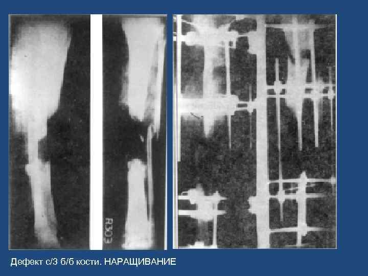 Дефект с/3 б/б кости. НАРАЩИВАНИЕ 