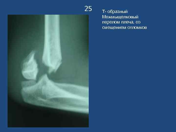 25 Т- образный Межмыщелковый перелом плеча, со смещением отломков 