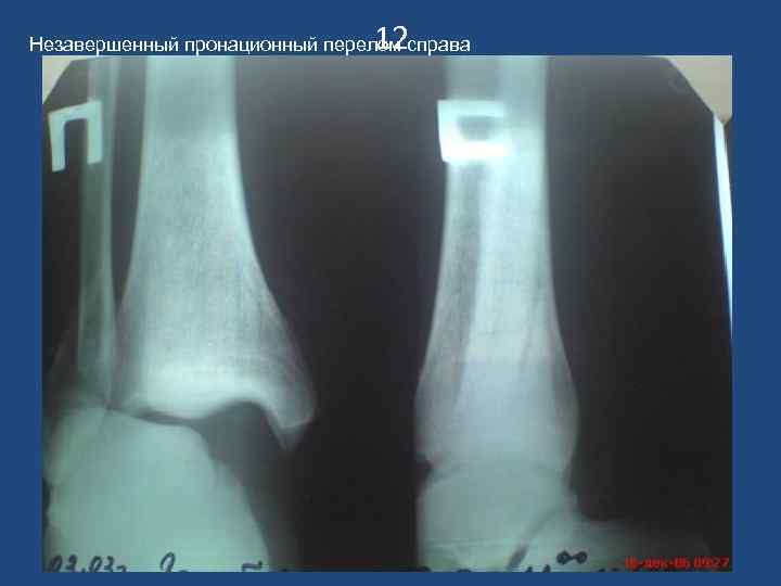 12 Незавершенный пронационный перелом справа 