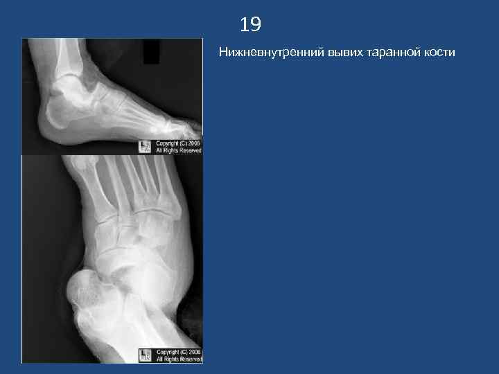 19 Нижневнутренний вывих таранной кости 