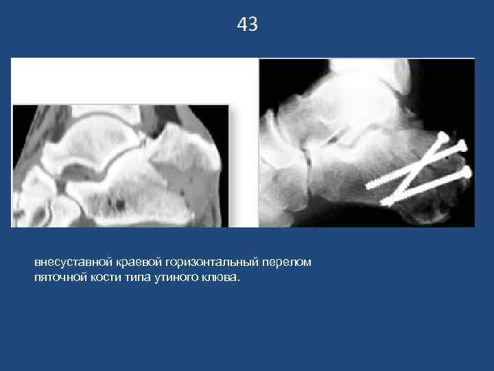 43 внесуставной краевой горизонтальный перелом пяточной кости типа утиного клюва. 