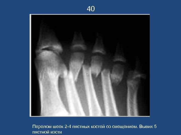 40 Перелом шеек 2 -4 пястных костей со смещением. Вывих 5 пястной кости 