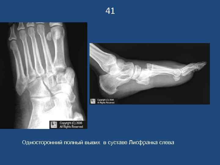 41 Односторонний полный вывих в суставе Лисфранка слева 