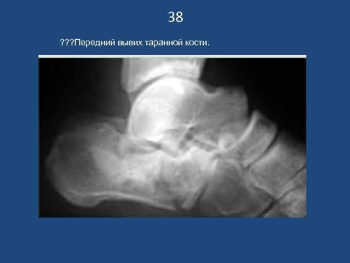 38 ? ? ? Передний вывих таранной кости. 