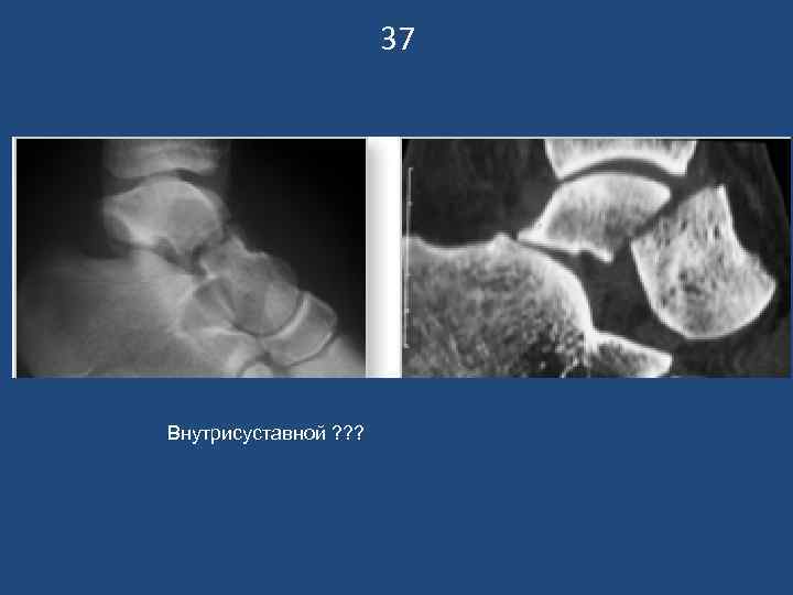 37 Внутрисуставной ? ? ? 