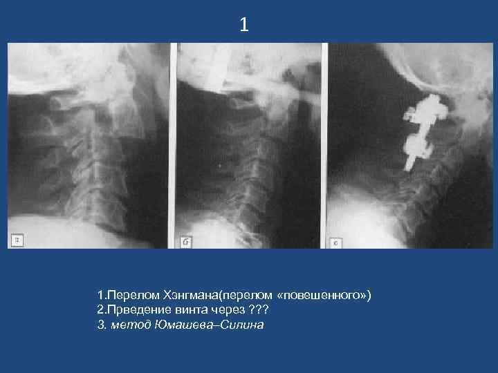 1 1. Перелом Хэнгмана(перелом «повешенного» ) 2. Прведение винта через ? ? ? 3.