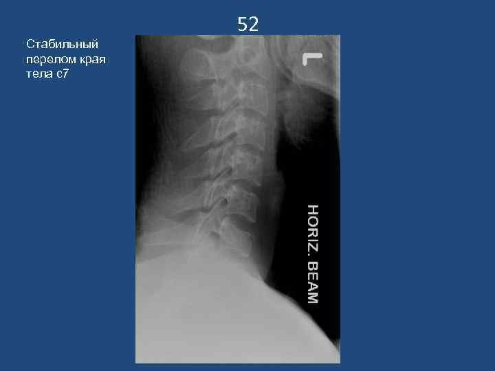 52 Стабильный перелом края тела с7 