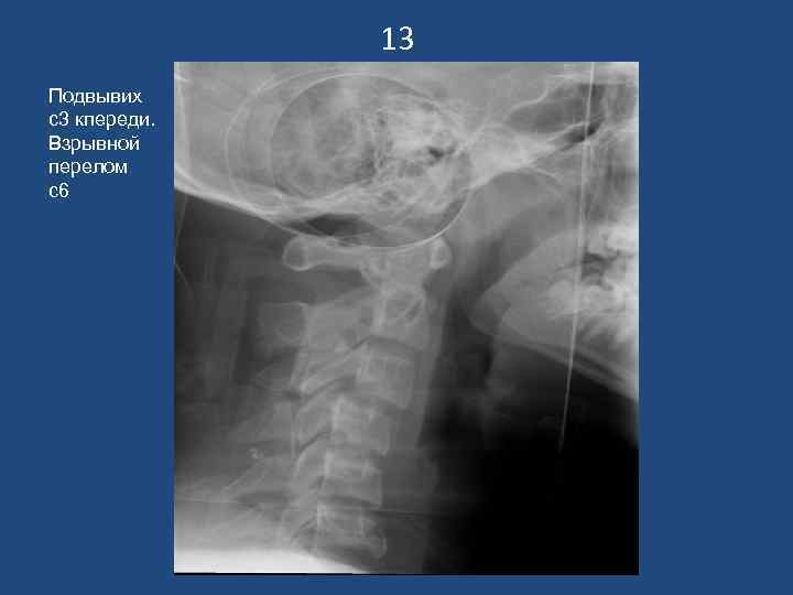 13 Подвывих с3 кпереди. Взрывной перелом с6 