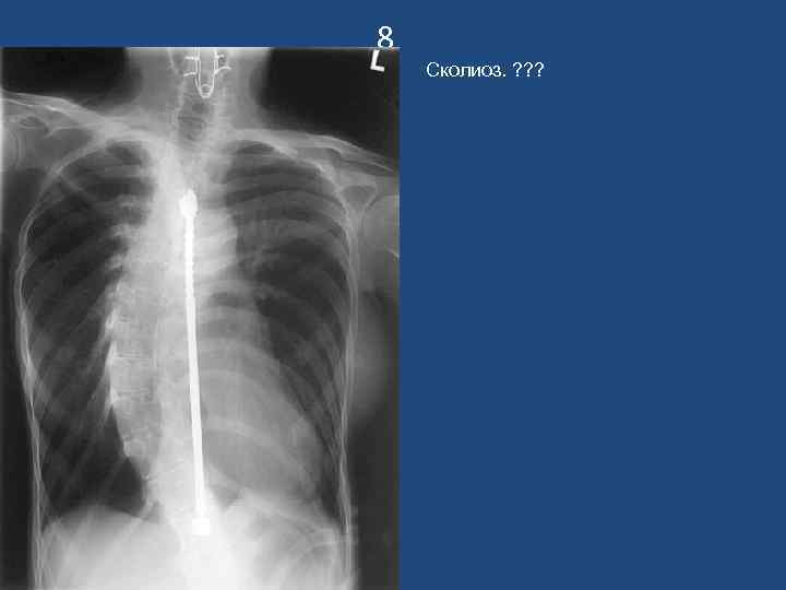 8 Сколиоз. ? ? ? 