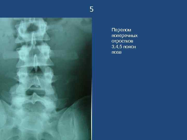 5 Перелом поперечных отростков 3, 4, 5 поясн позв 