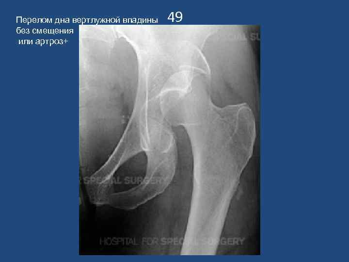 Перелом вертлужной впадины. Краевой перелом вертлужной впадины рентген. Импрессионный перелом вертлужной впадины. Оссификат вертлужной впадины. Переломы вертлужной впадины чрезсуставной.