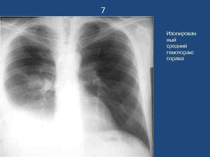 7 Изолирован ный средний гемоторакс справа 