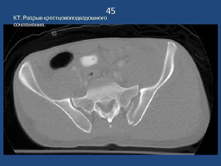 45 КТ. Разрыв крестцовоподвздошного сочленения. 