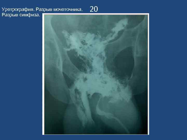 Уретрография. Разрыв мочеточника. Разрыв симфиза. 20 