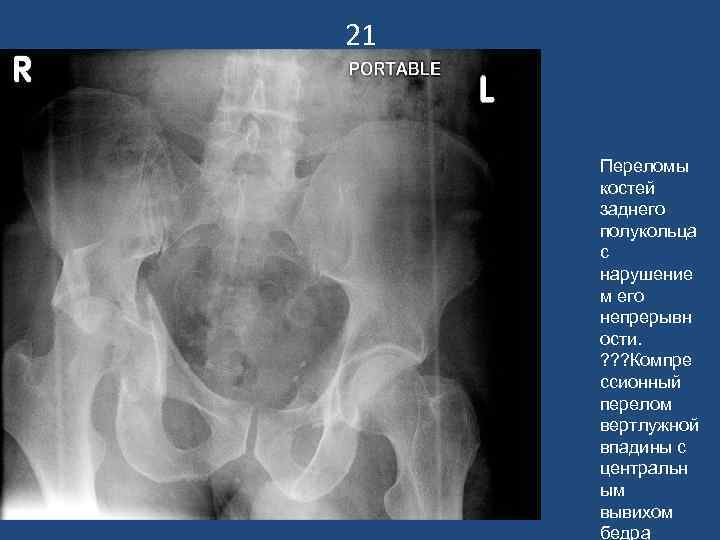 21 Переломы костей заднего полукольца с нарушение м его непрерывн ости. ? ? ?