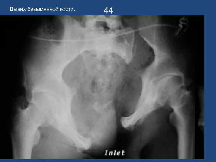 Вывих безымянной кости. 44 